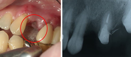 １本の歯を失った場合 治療前