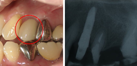 １本の歯を失った場合 治療後