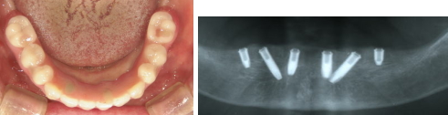 歯をすべて失った場合のインプラント治療後